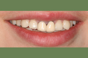 30 year old female, chief complaint &mdash; 'Old crowns that do not fit well.' <strong>Diagnosis:</strong> Decay and gum disease around old metal crowns. <strong>Treatment:</strong> Cosmetic gum surgery and porcelain crowns replaced two front teeth and veneers on upper lateral teeth.