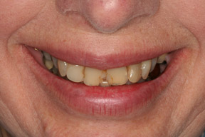 70 year old female, chief complaint &mdash; 'Aching teeth when chewing and teeth always breaking.' <strong>Diagnosis</strong>: Old dentistry and collapsed bite. <strong>Treatment:</strong> Full mouth reconstruction with all porcelain crowns.