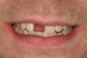28 year old male, chief complaint &mdash; 'Missing front tooth from a childhood accident.' <strong>Diagnosis:</strong> Inadequate bone to support an implant. <strong>Treatment:</strong> Maryland bridge &ndash; a very conservative treatment to replace one missing tooth without an implant.