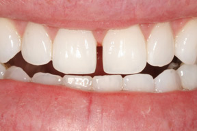 50 year old female, chief complaint &mdash; 'Big gap between my teeth that reopened after two orthodontic treatments.' <strong>Diagnosis:</strong> Diastema resulting from a mismatch between the upper and lower tooth size. <strong>Treatment:</strong> Veneers designed to fit in the space between the teeth. This is a very conservative approach that required no change to the patient's natural enamel.