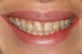 40 year old female, chief complaint &mdash; 'Short teeth that a dentist covered with bonding and became yellowed over time.' <strong>Diagnosis:</strong> Worn and stained resin veneers, teeth shortened by tooth grinding habit. <strong>Treatment:</strong> Porcelain veneers on upper front teeth that filled out the entire smile line.