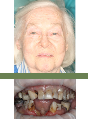 <strong>What concerned the patient?</strong> Embarrassed to smile and difficulty eating. <strong>Condition:</strong> Multiple decayed and missing teeth. <strong>What was done:</strong> Designed bridges that could be cemented to the few remaining healthy teeth. Restored aesthetics and function just like natural teeth.  No dentures and no implants required. Very affordable treatment plan with low maintenance. Completed in four primary office visits. <strong>Patient's Comments After Treatment:</strong> Erma used to hide her mouth with her hand whenever she spoke because she was so embarrassed about her teeth.  She said she was so happy with her result that she was ready to buy new lipstick to show off her smile.